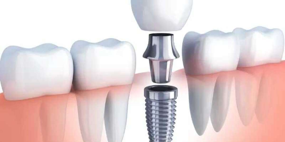 Comprehensive Guide to Teeth Braces: Types, Process, and Maintenance